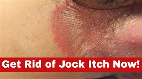 jock itch wiki|how to identify jock itch.